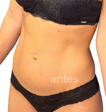 Antes