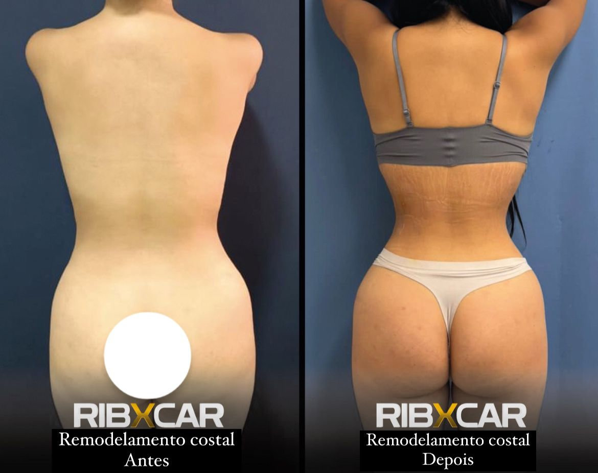 Remodelamento Costal RibXcar