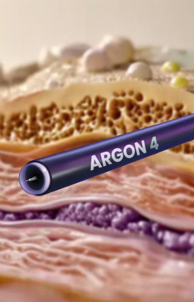 Equipamento Argon 4, tecnologia usada em cirurgia plástica na Arte Clínica