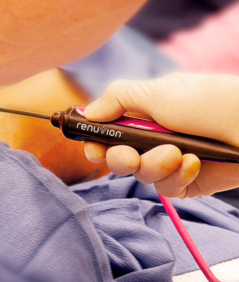 Tecnologia Renuvion aplicada em lipoaspiração