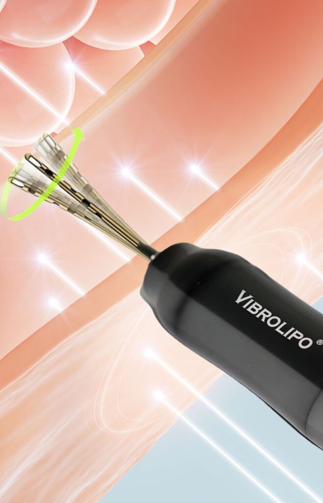Equipamento Vibrolipo, tecnologia usada em lipoaspiração na Arte Clínica