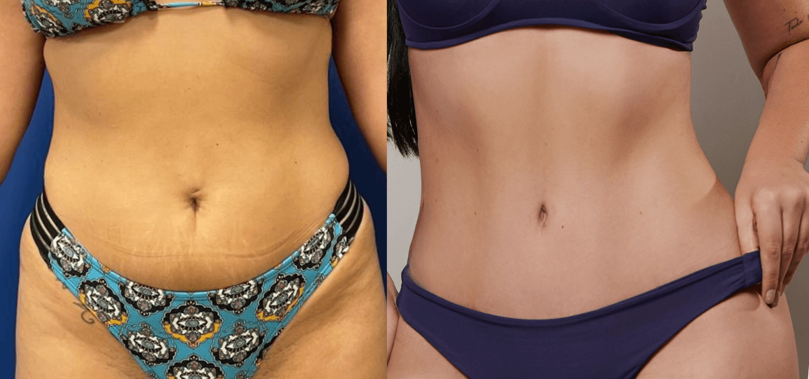 Antes e depois abdominoplastia HD