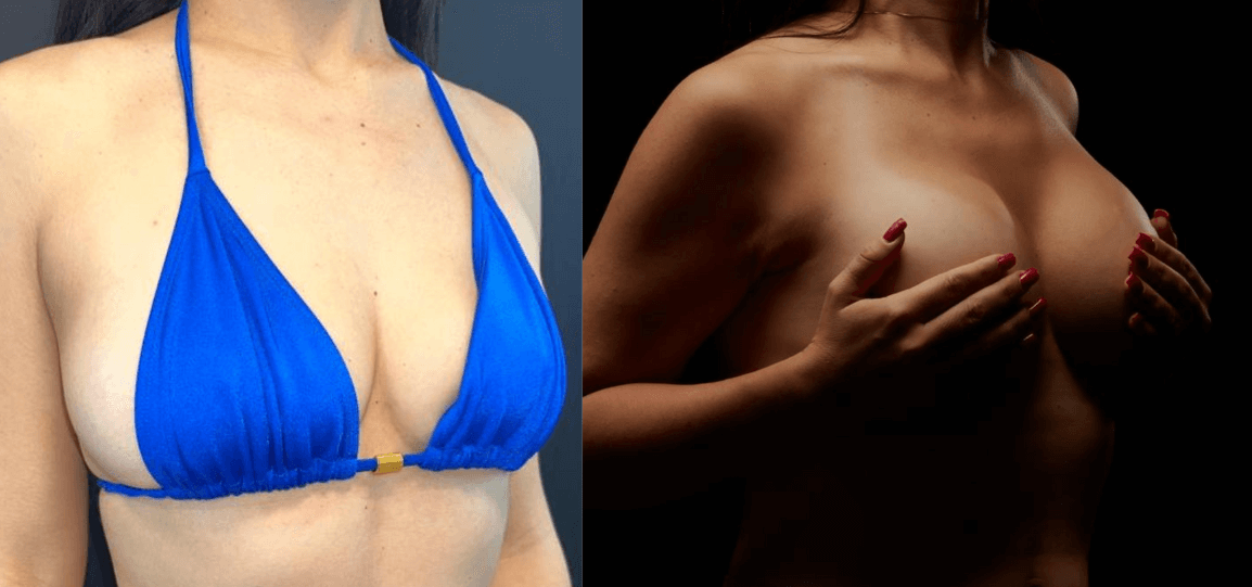 Antes e depois Mastopexia com prótese