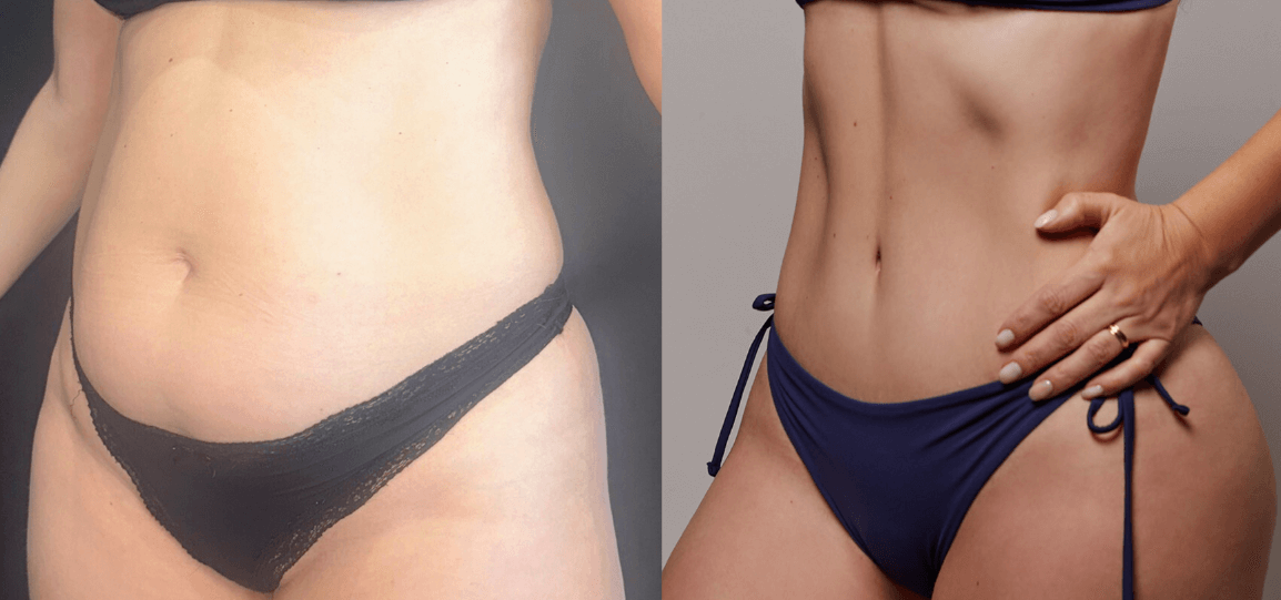 Antes e depois M.I.R.E.L.A